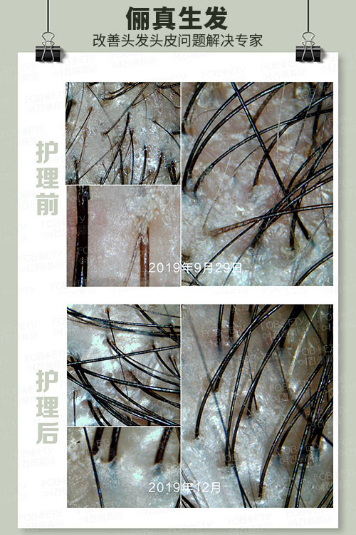 頭油、頭癢